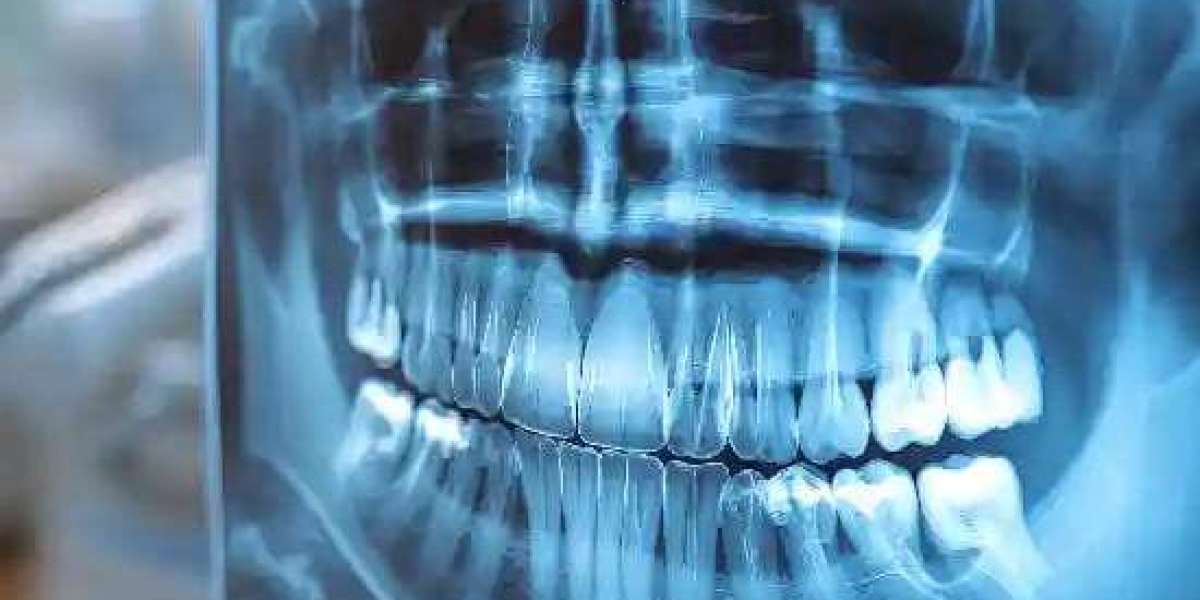 The Importance of OPG Scans in Oral Health