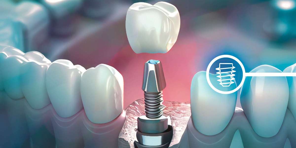 Cost-Effective and Reliable: Getting Teeth Implants in Mumbai