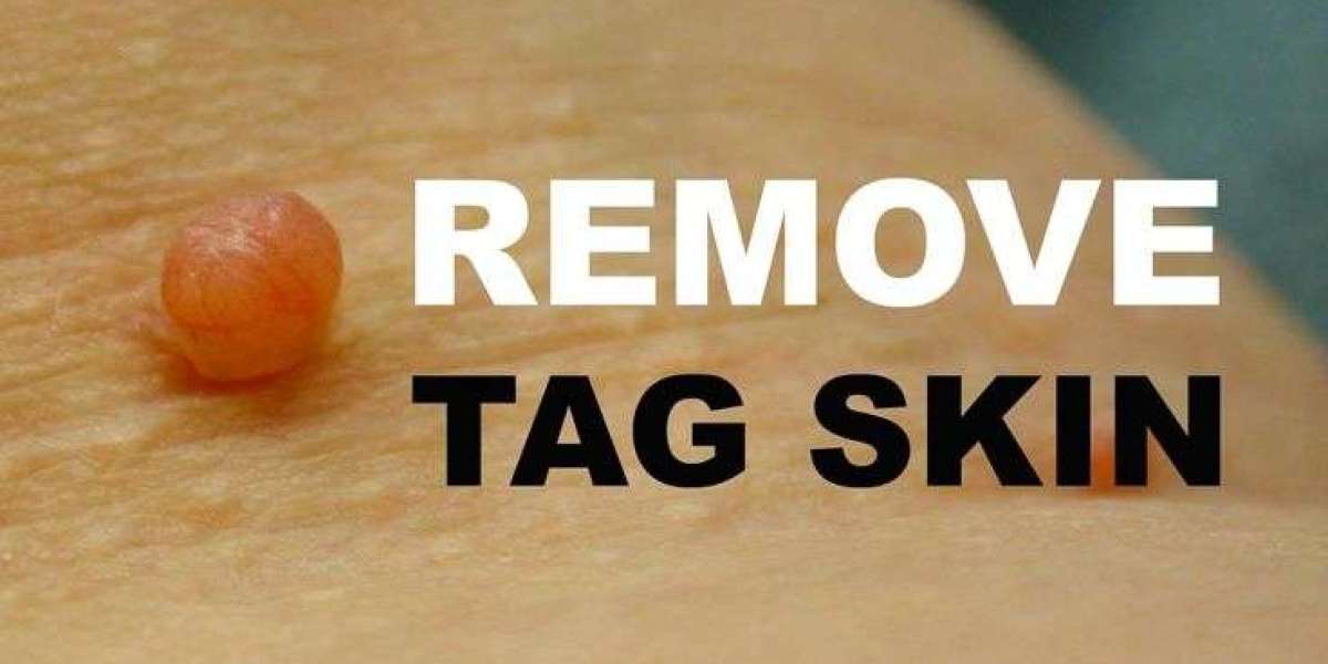 Skin Tag Removal Price: Options for Every Budget