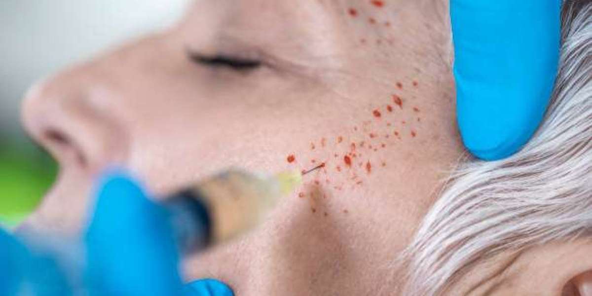 Top Benefits of PRP Treatment for Face in Dubai’s Climate