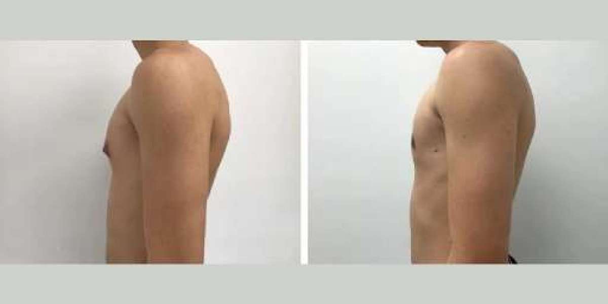 The Benefits of Gynecomastia Surgery in Dubai: Why the Best Surgeons Are Crucial