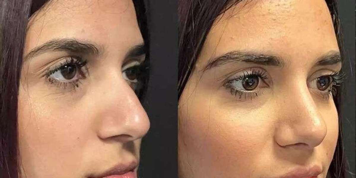 Best Septoplasty Surgeons in Dubai: Where Precision Meets Compassion