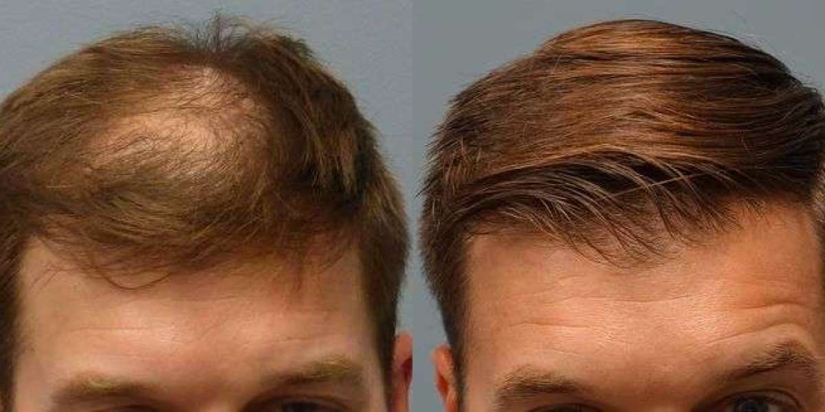 Rediscover Your Confidence: The Ultimate Guide to FUE Hair Transplant in Lahore