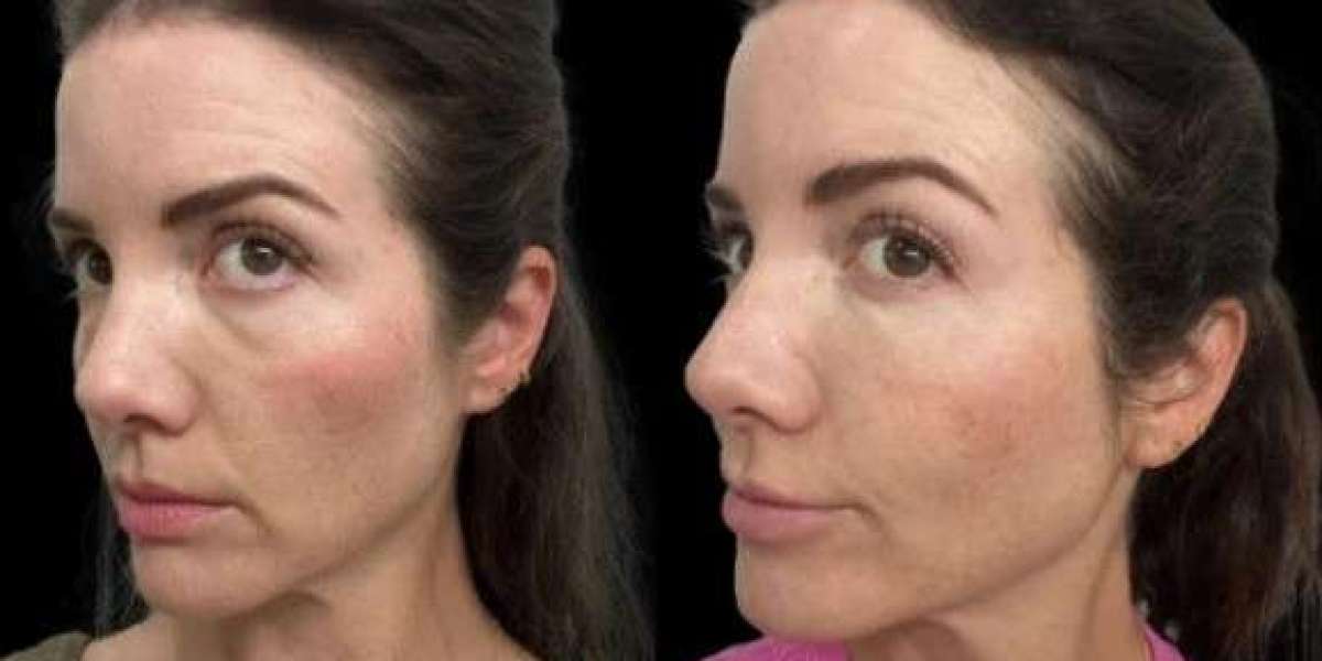 Why Best Doctors in Dubai Excel at Dark Circles Treatment