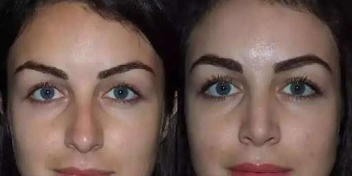 Rhinoplasty in Dubai: Non-Surgical Options vs. Surgical Results