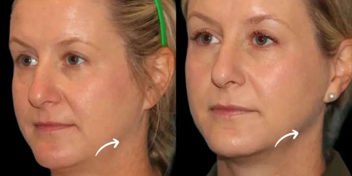 Sculptra Fillers for Cheek Enhancement at Dubai’s Best Aesthetic Clinic