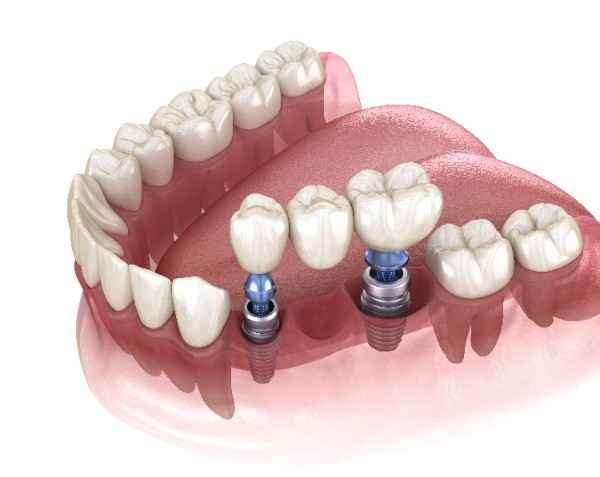 dental Implant Bristol