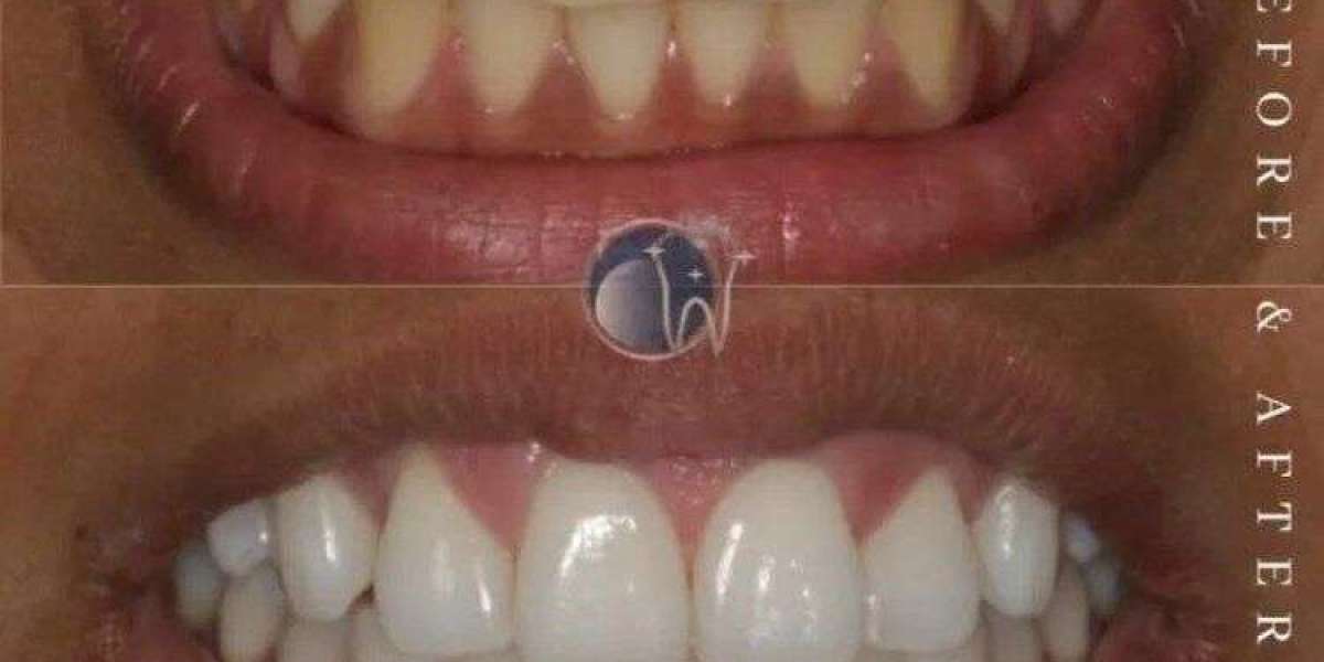 Get a Bright Smile with Crest Professional Effects Whitening from The White Smiles