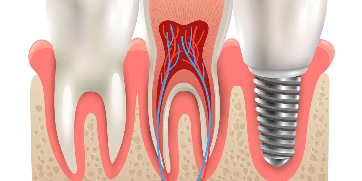 Dental Implant Solutions in London: Expertise, Comfort, and Care at Mindful Dentist