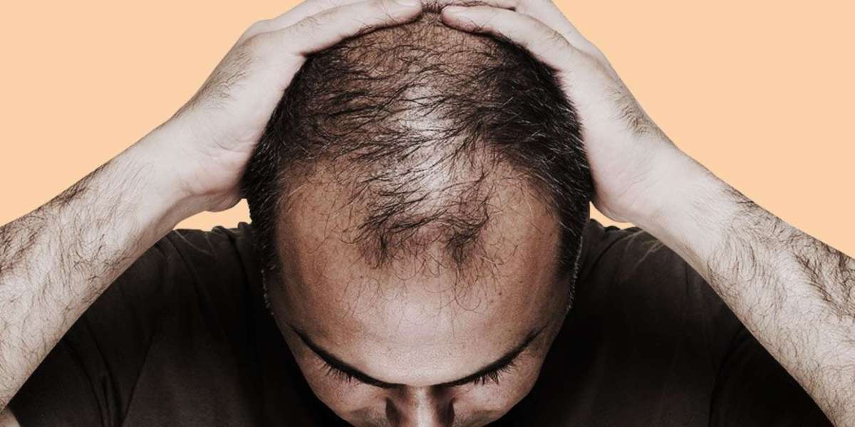 Top 5 Tips for a Successful Hair Patch Clinic Experience