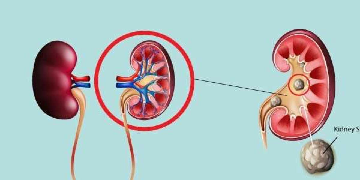 What Dissolves Kidney Stones Fast: Facts vs. Fiction