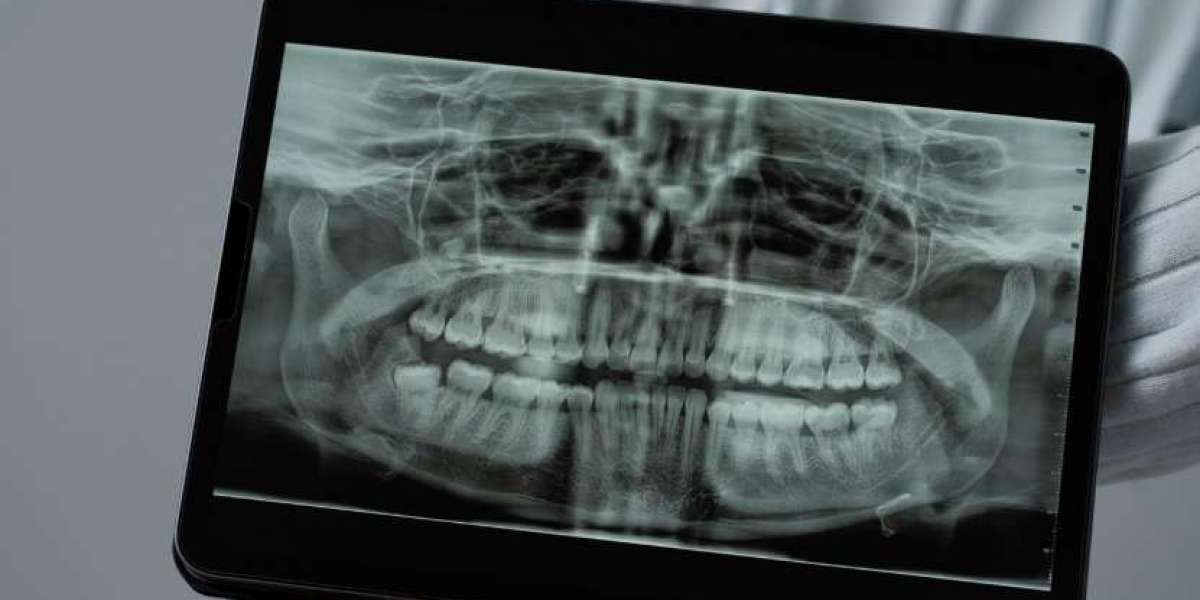 Full Mouth X-Rays: When Are They Necessary in Modern Dentistry?