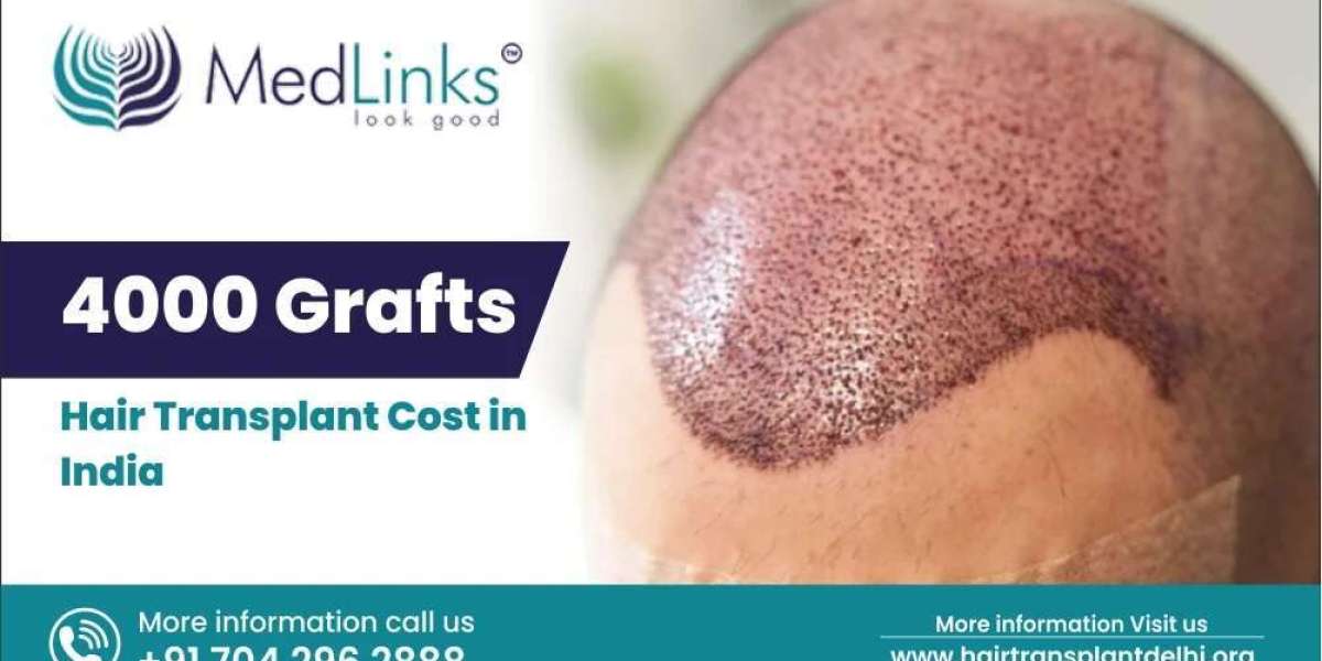 4000 Grafts Hair Transplant Cost in India: What You Should Know