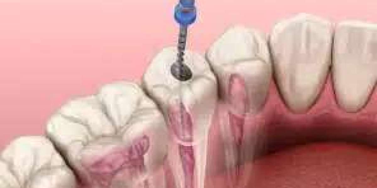 Speak, Eat, Smile: Top Reasons to Choose Implants
