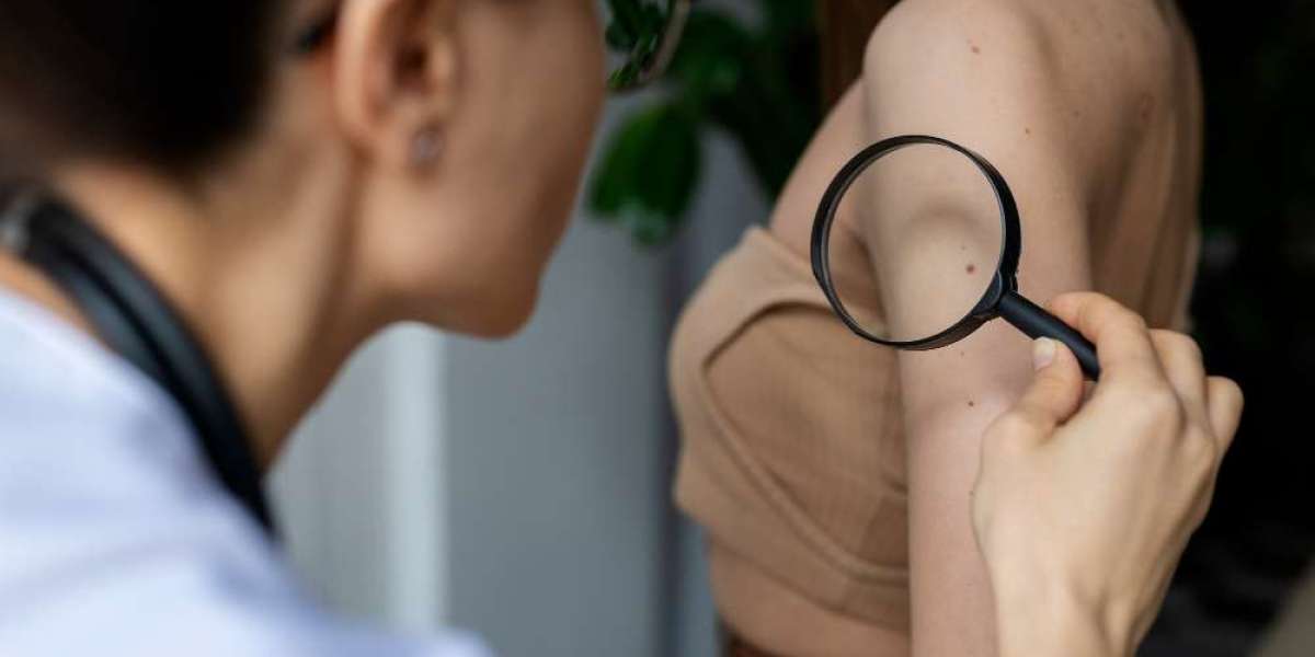 Best Keloid Specialist Advice: Effective At-Home Treatments