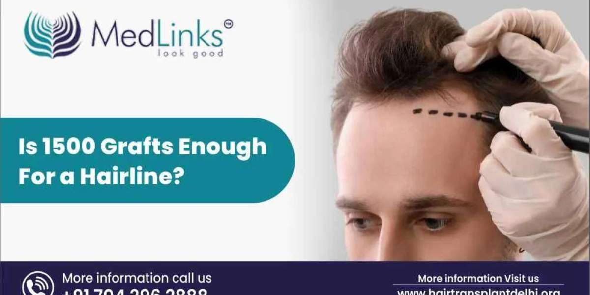 Is 1500 Grafts Enough for a Hairline?