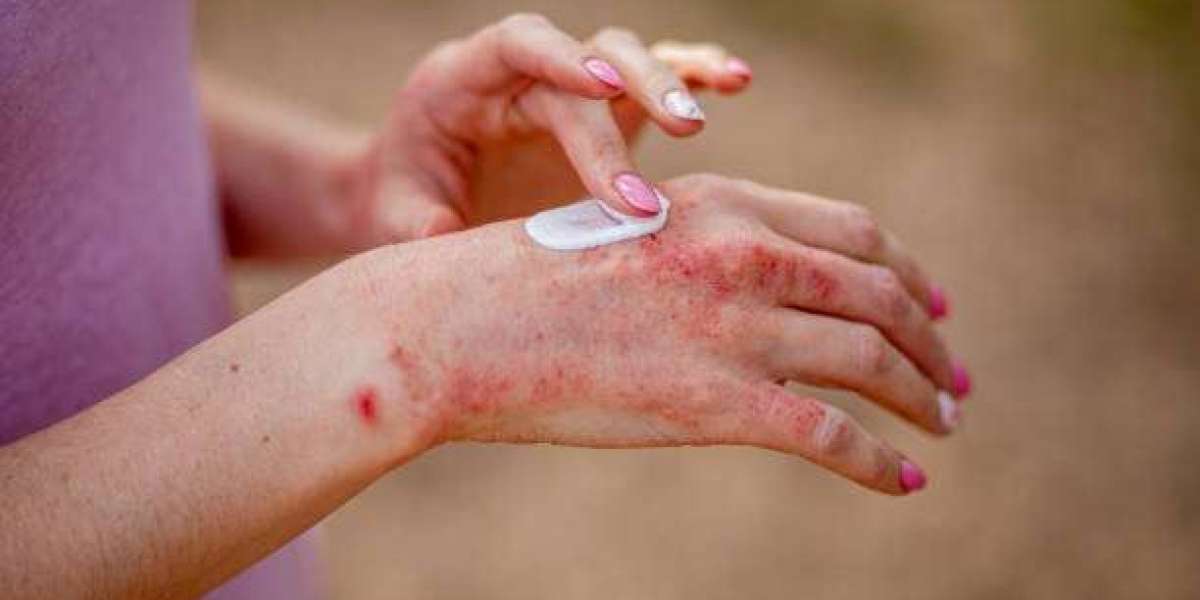 Can Eczema Cream Be Used Daily? Myths and Facts