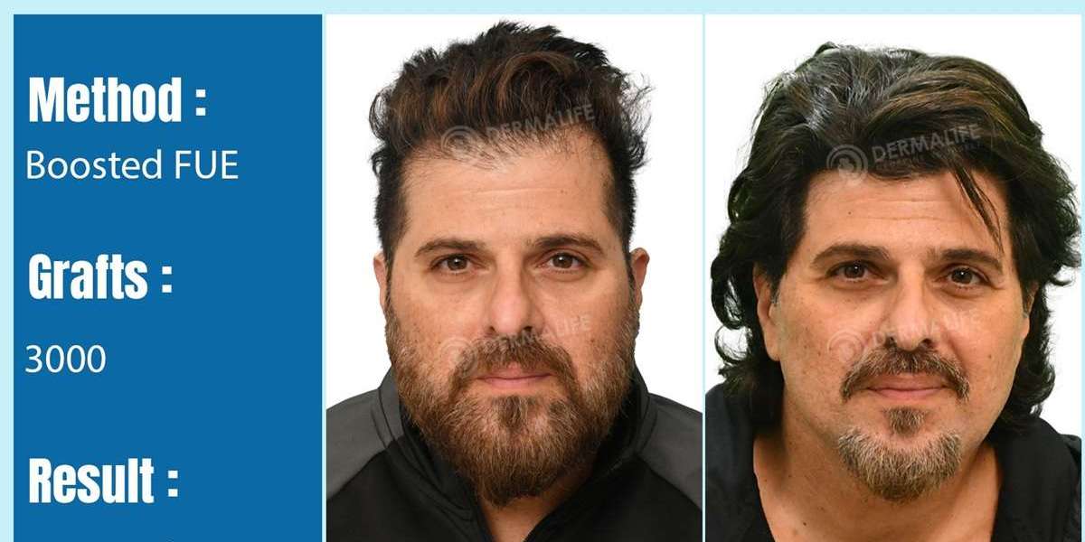 Get a Full Head of Hair from the Best Hair Transplant Clinic in India