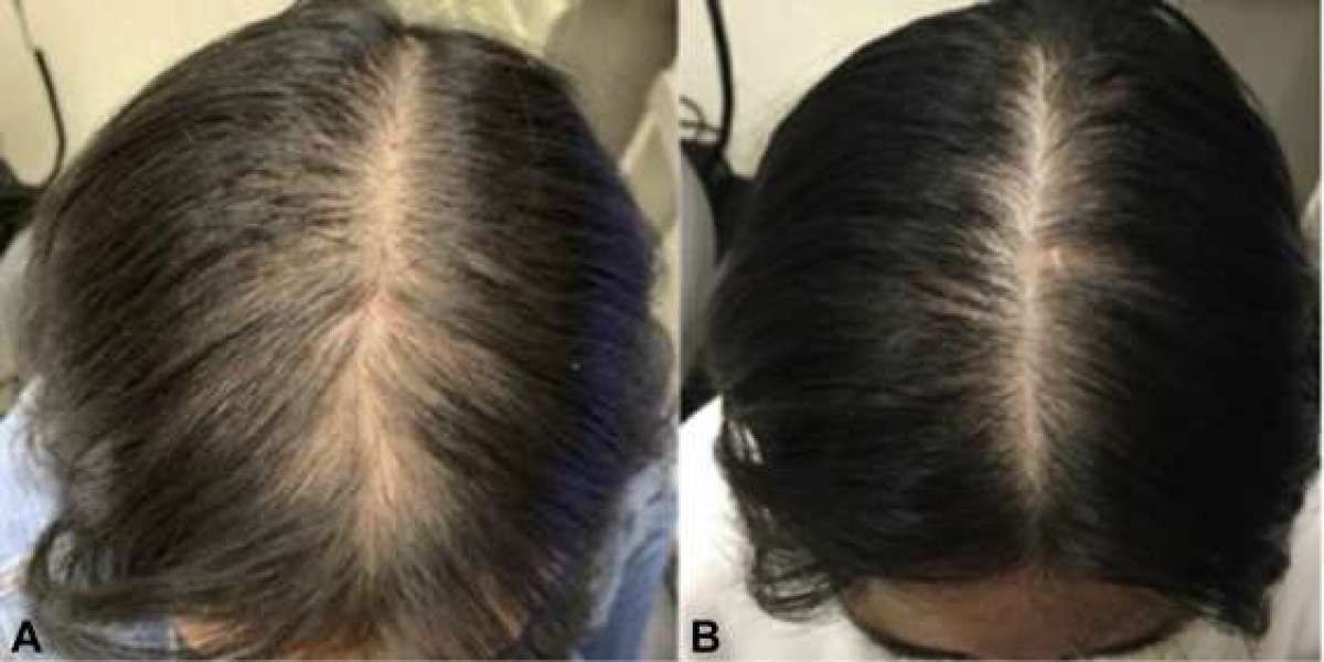 Restoring Confidence: Female Hair Loss Treatment in Lahore