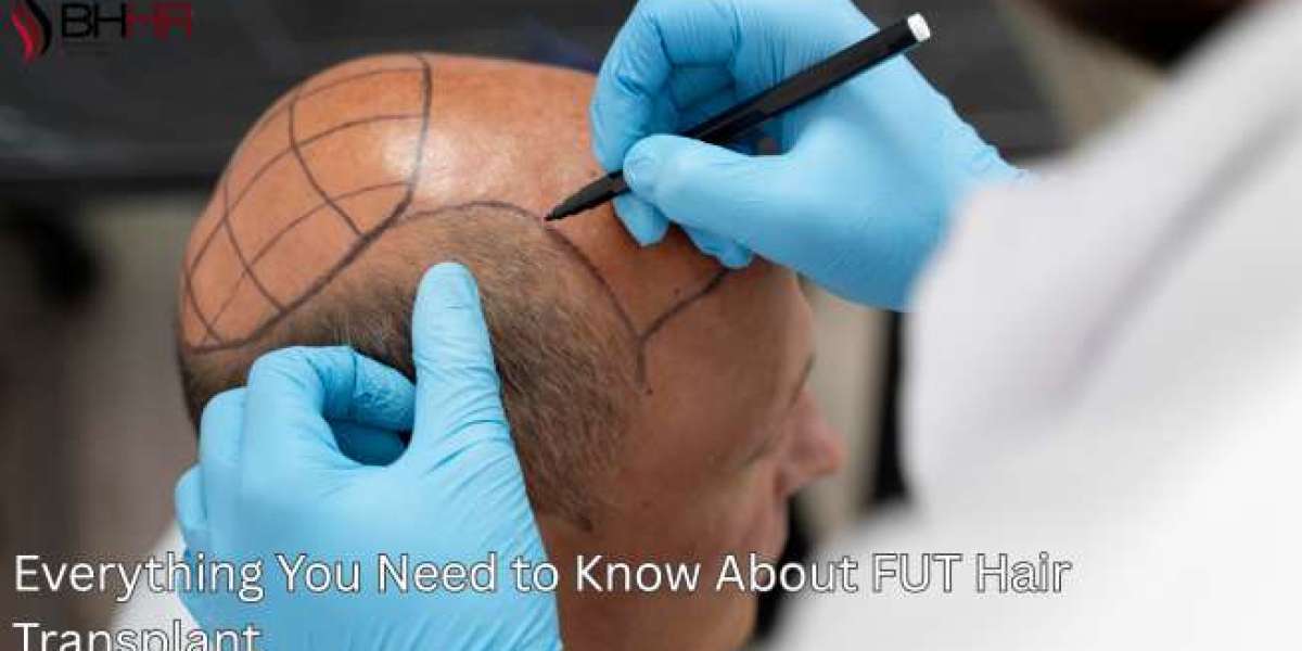 Everything You Need to Know About FUT Hair Transplant