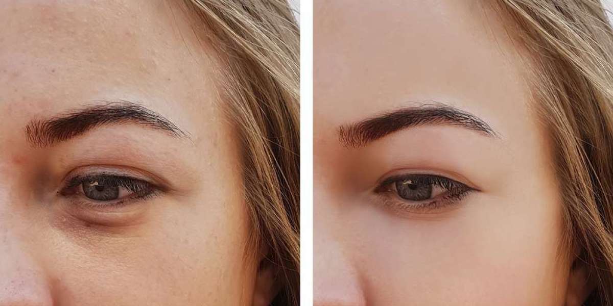 Eyelid Bag Surgery Dubai: Before and After Transformations
