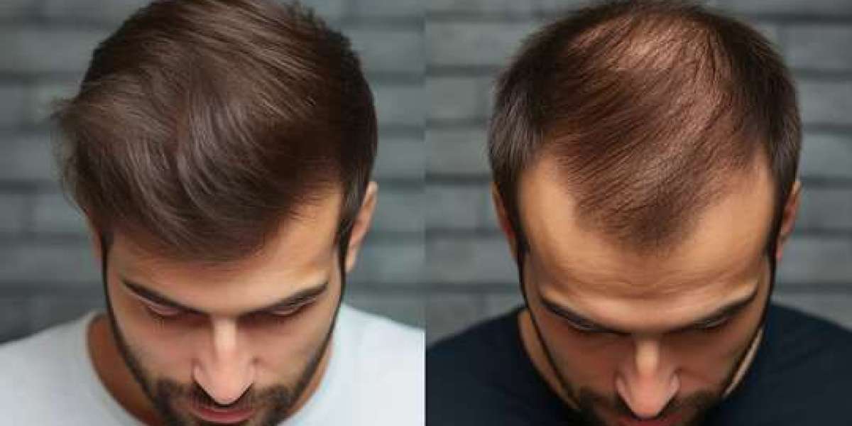 Hair Loss Treatments in Jeddah: Restore Hair Growth with Proven Solutions