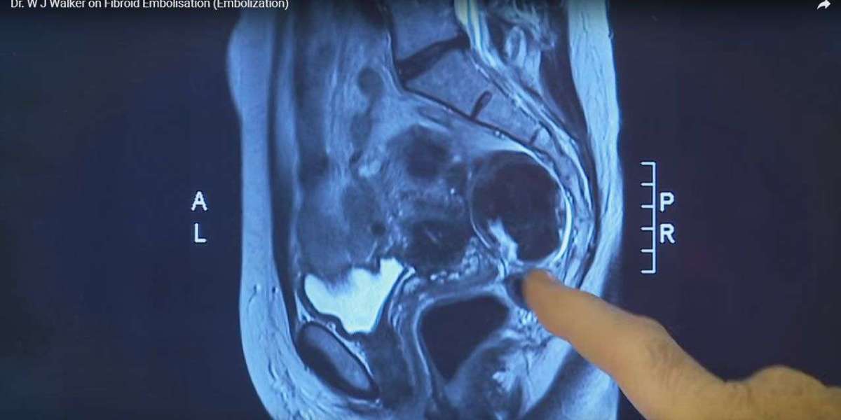 Uterine Fibroid Treatment Market Competition Analysis: Key Players, Strategies, and Market Positioning Insights