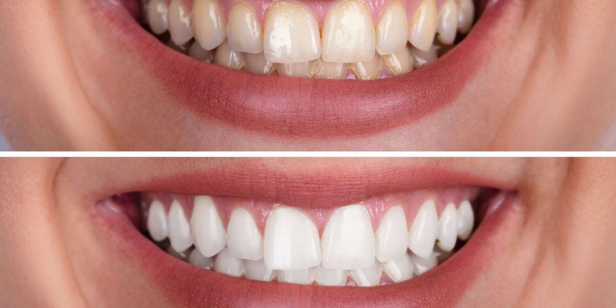 Teeth Whitening for Yellow Teeth: Effective Solutions Explained
