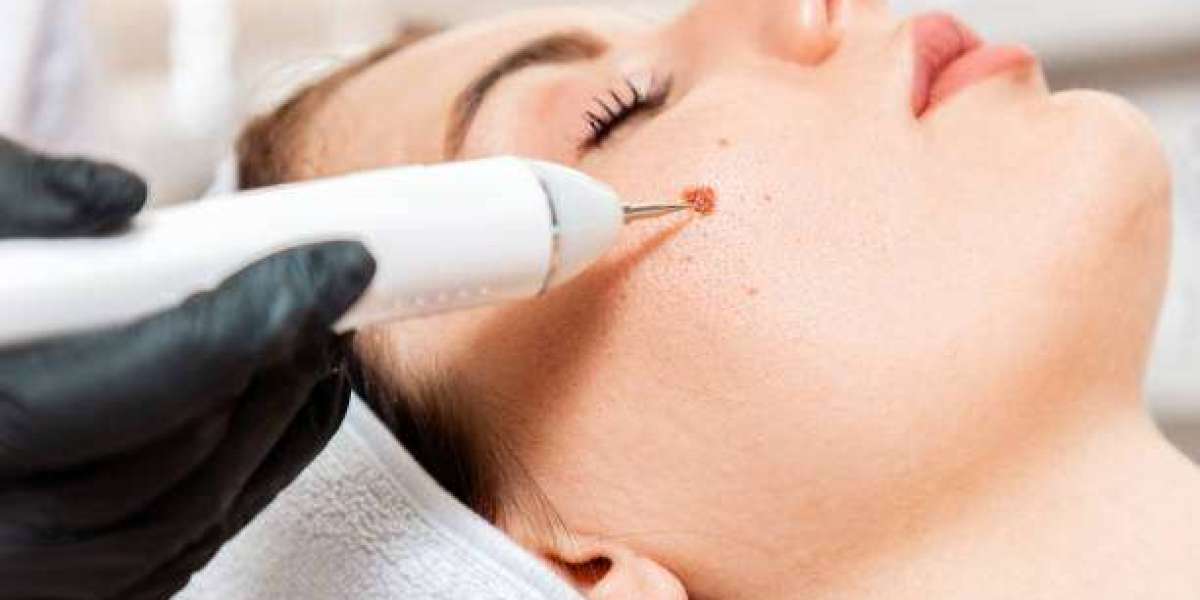 Professional Approaches to Wart Removal