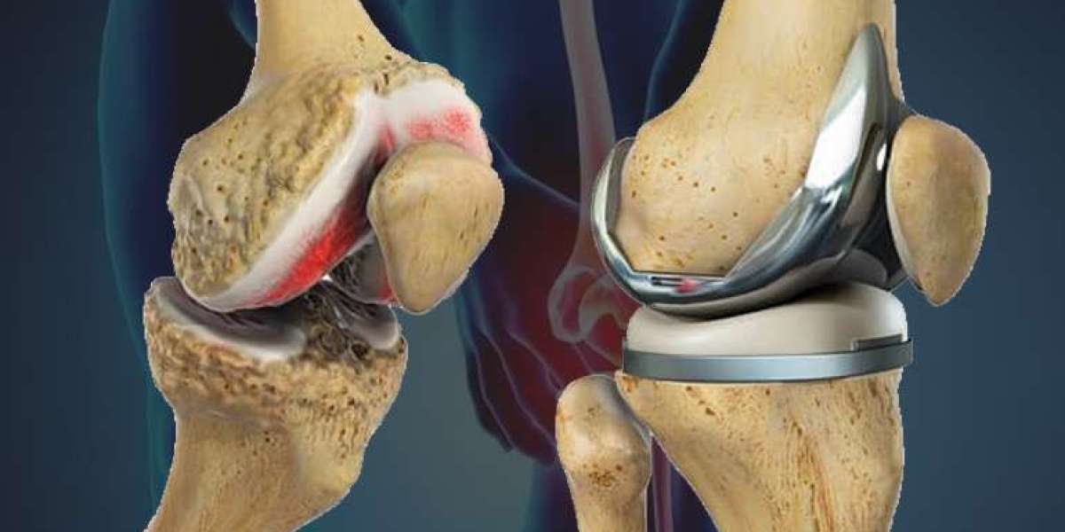 Top Qualities of the Best Knee Replacement Surgeon in Jaipur