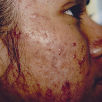 Glowing Look with Chemical Face Peels in Houston TX | FACE/FIT