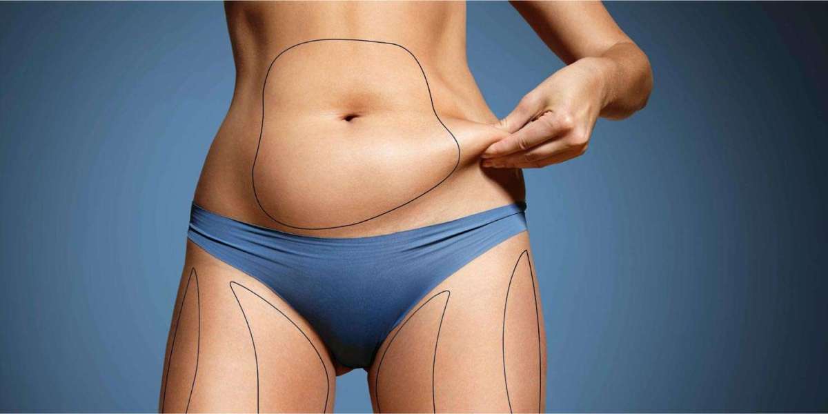 Who Is an Ideal Candidate for Abdominoplasty in Dubai