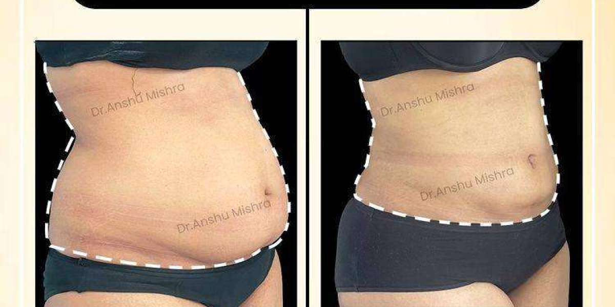 Liposuction Surgery in Dubai with Dr. Hans – Cost, Expertise & Results