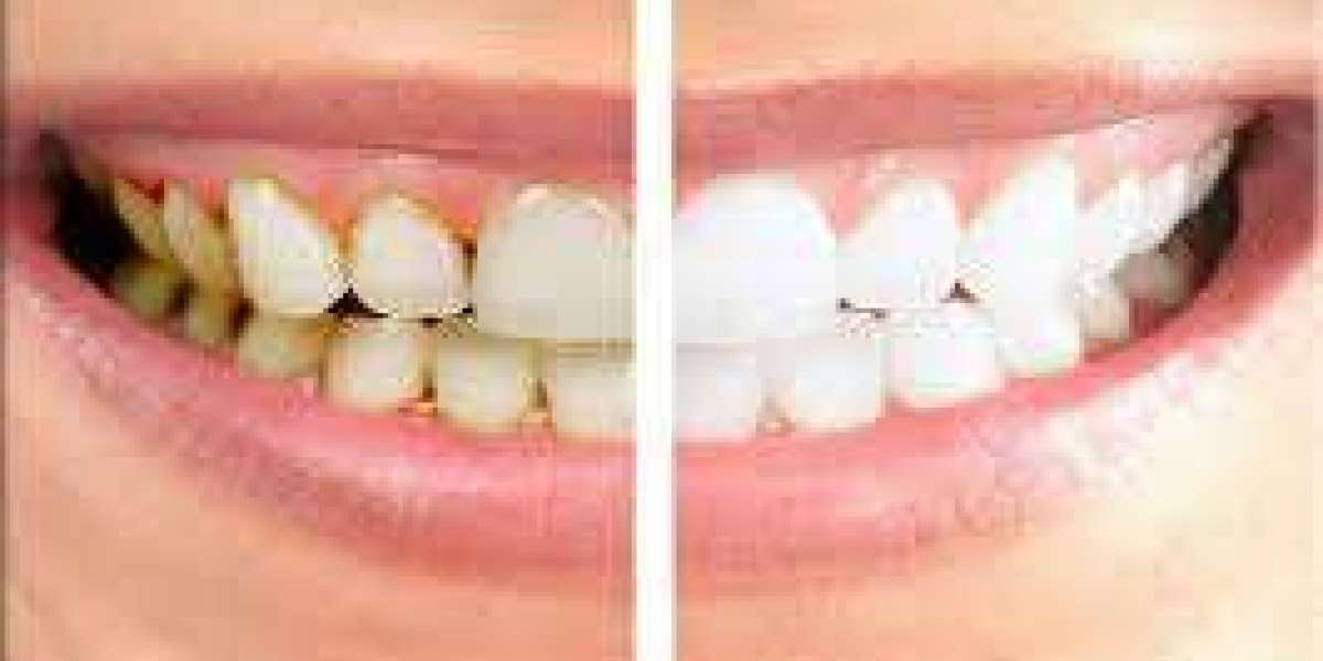 Dental Crown Dubai: Types and Materials to Consider