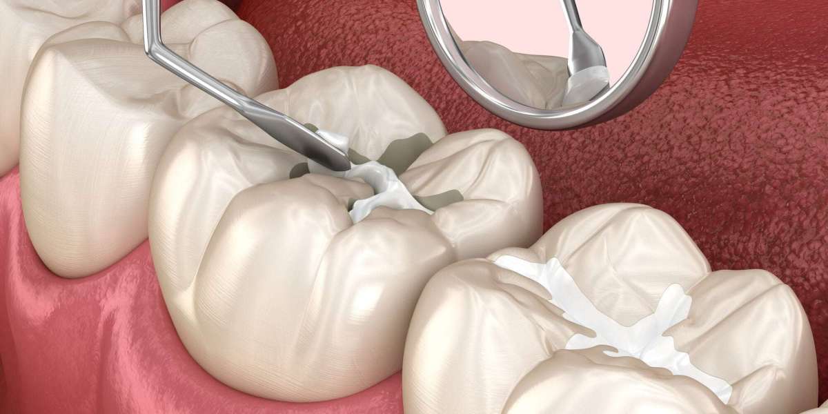 Dental Sealants Market Opportunities Forecasting Expansion, Trends, and Technological Advances Across Regions