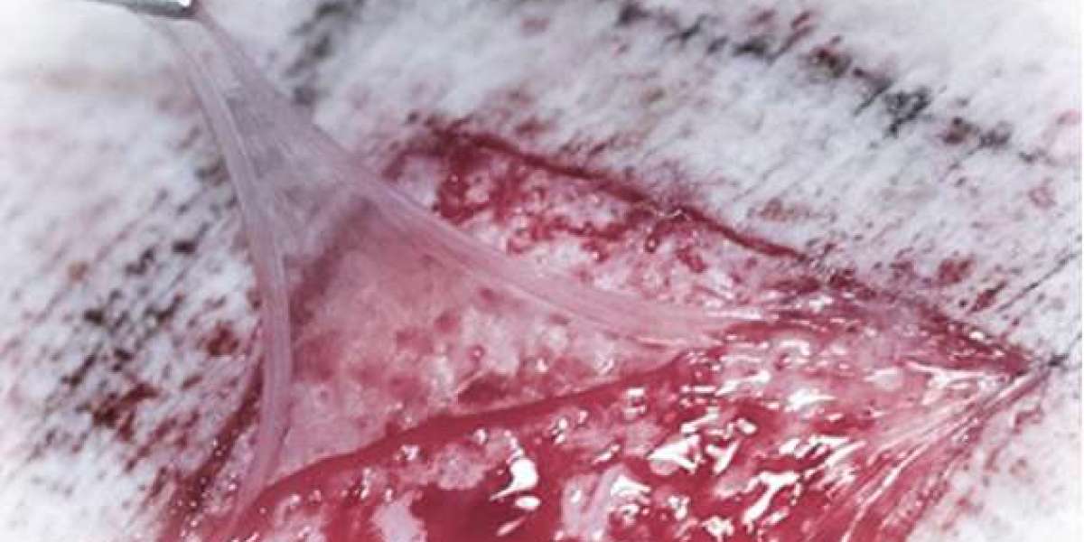 Helicoll Graft in Advanced Wound Care