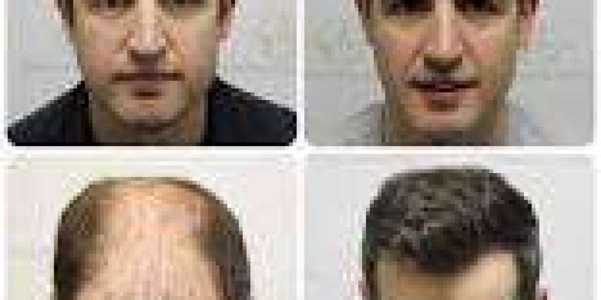 Hair Transplant London, UK - Westminster Medical Group