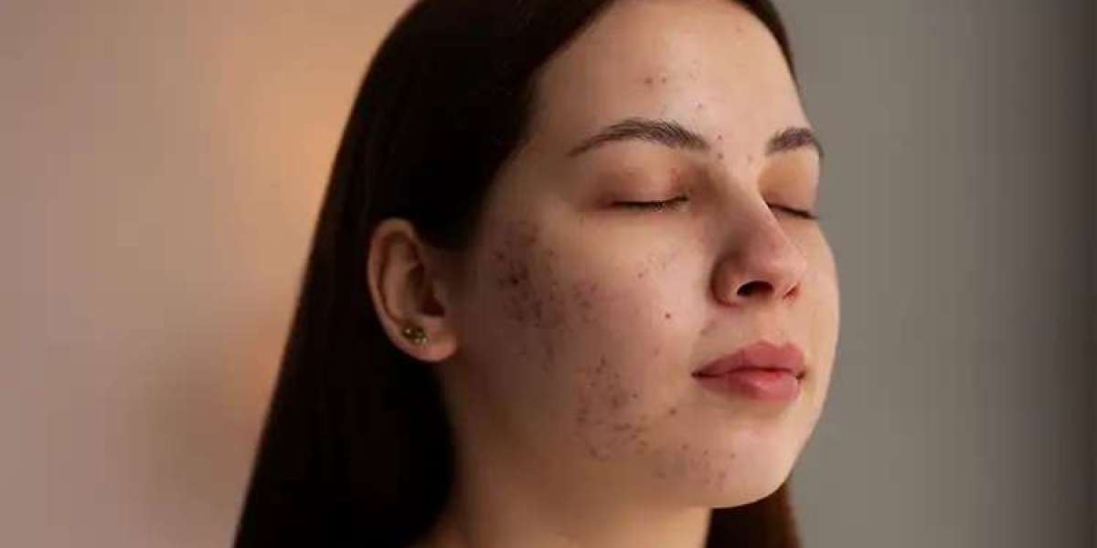 How To Remove Acne Scars Permanently, According to Experts Best Dermatologist in Ludhiana