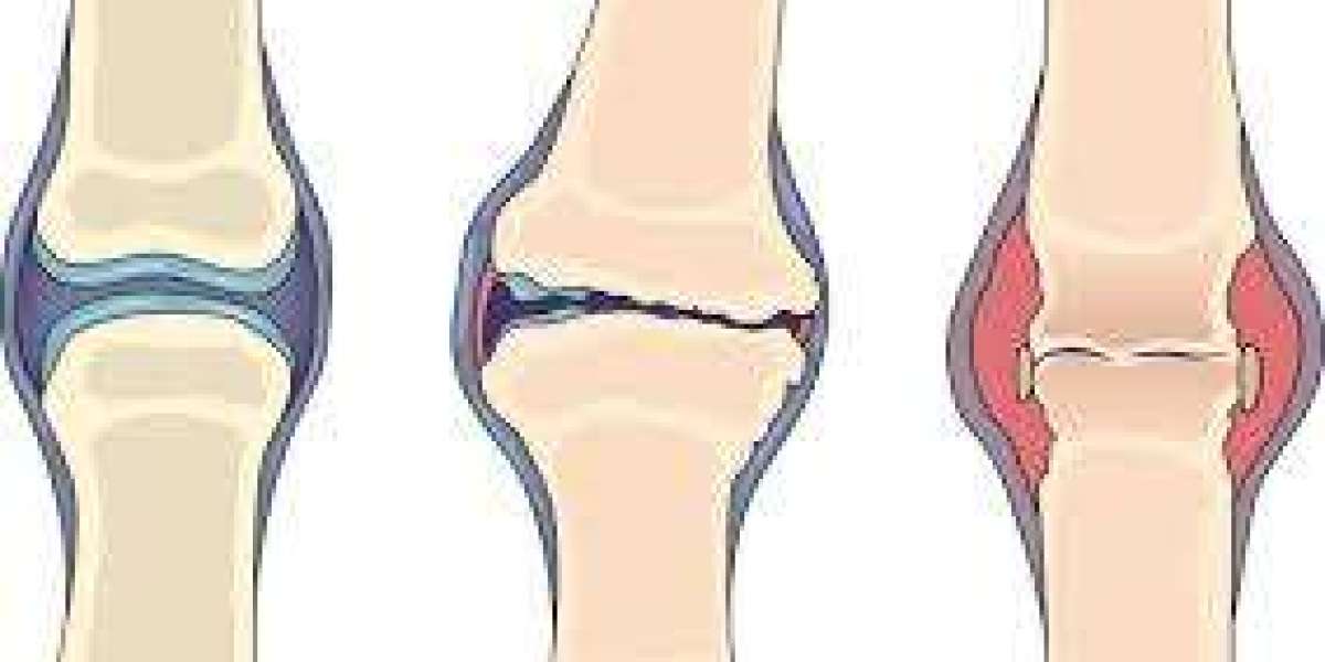 OA and RA Explained: A Complete Guide to Joint Health