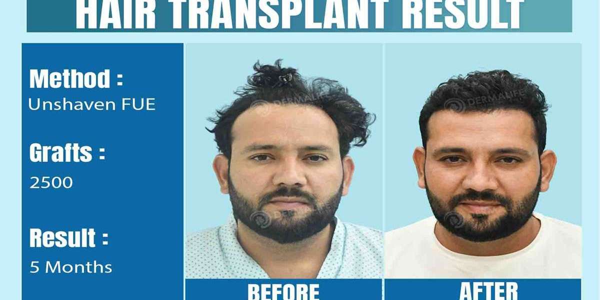 Does Hair Transplant Look Natural? Fact vs. Fiction