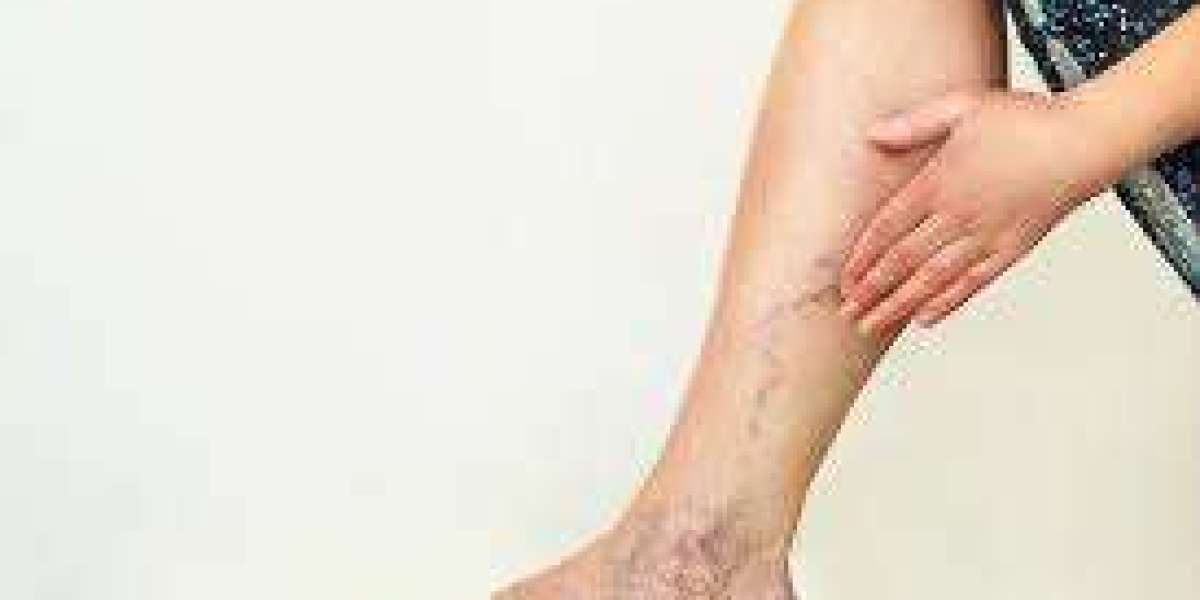How Varicose Veins Can Affect Your Daily Life