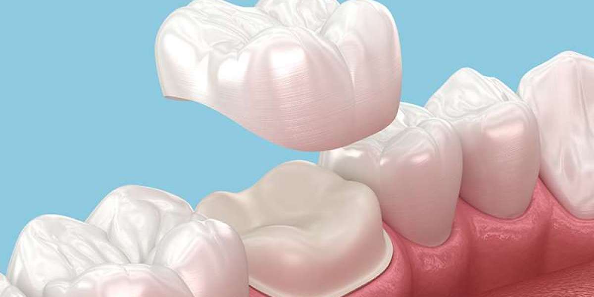 Perfect Your Smile with Dental Crowns in Dubai