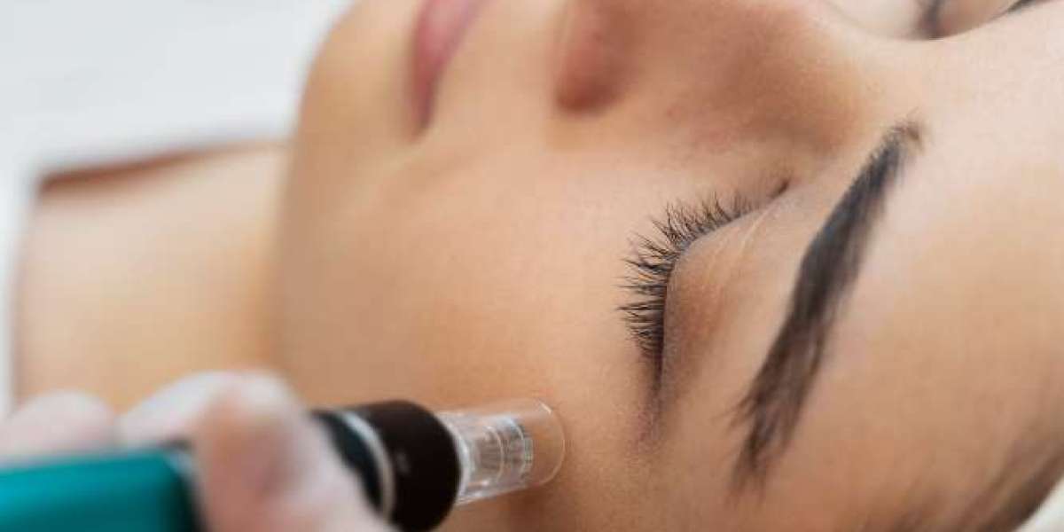 Microneedling Athens ga