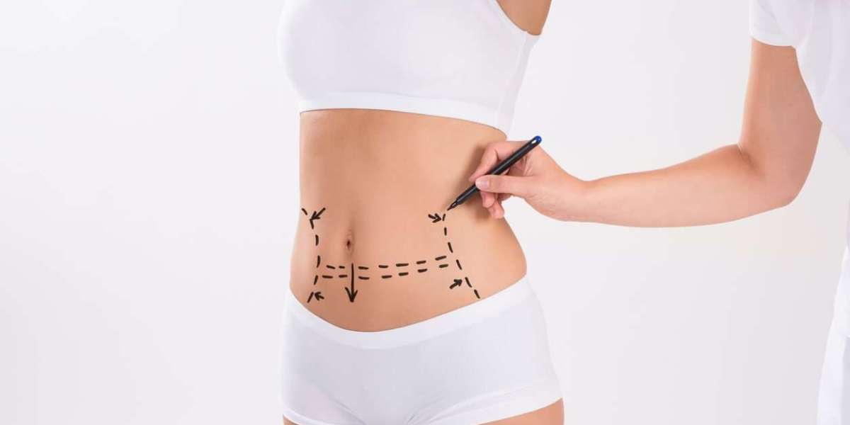 The Recovery Process After Liposuction in Dubai: What to Expect