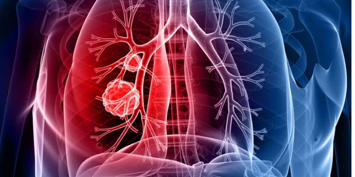 ICD-10 Codes for Lung Cancer Screening: Complete Medical Guide