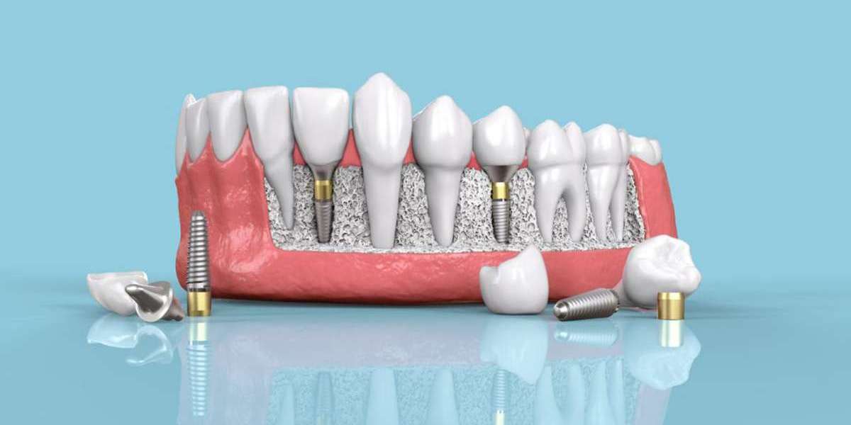Why Choose Aesthetic Smile Dental Clinic for Dental Implants in India?