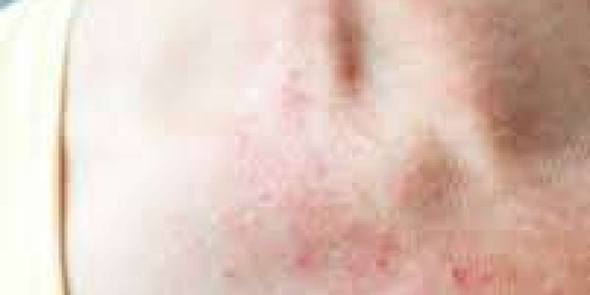 Atopic Dermatitis Market Overview, Biologic Pipeline Expansion, and Evolving Global Healthcare Strategies