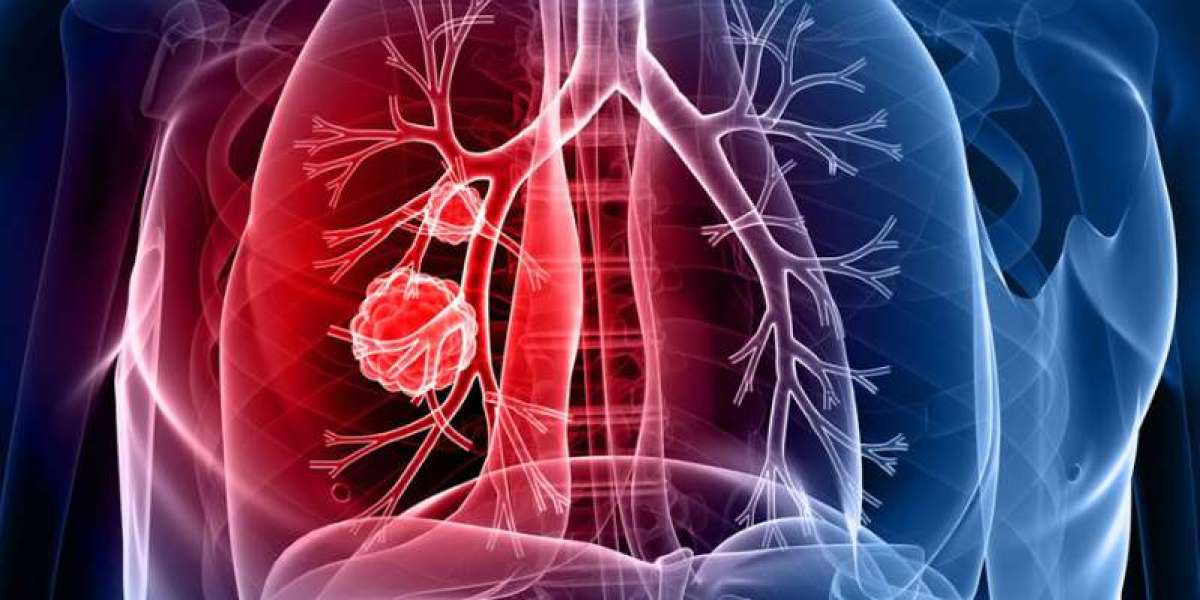 Lung Cancer Screening: Correct ICD-10 Codes for Documentation | Best Writes Links