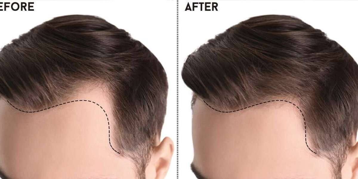 Unlocking Confidence: The Ultimate Guide to Hair Transplants in Pakistan