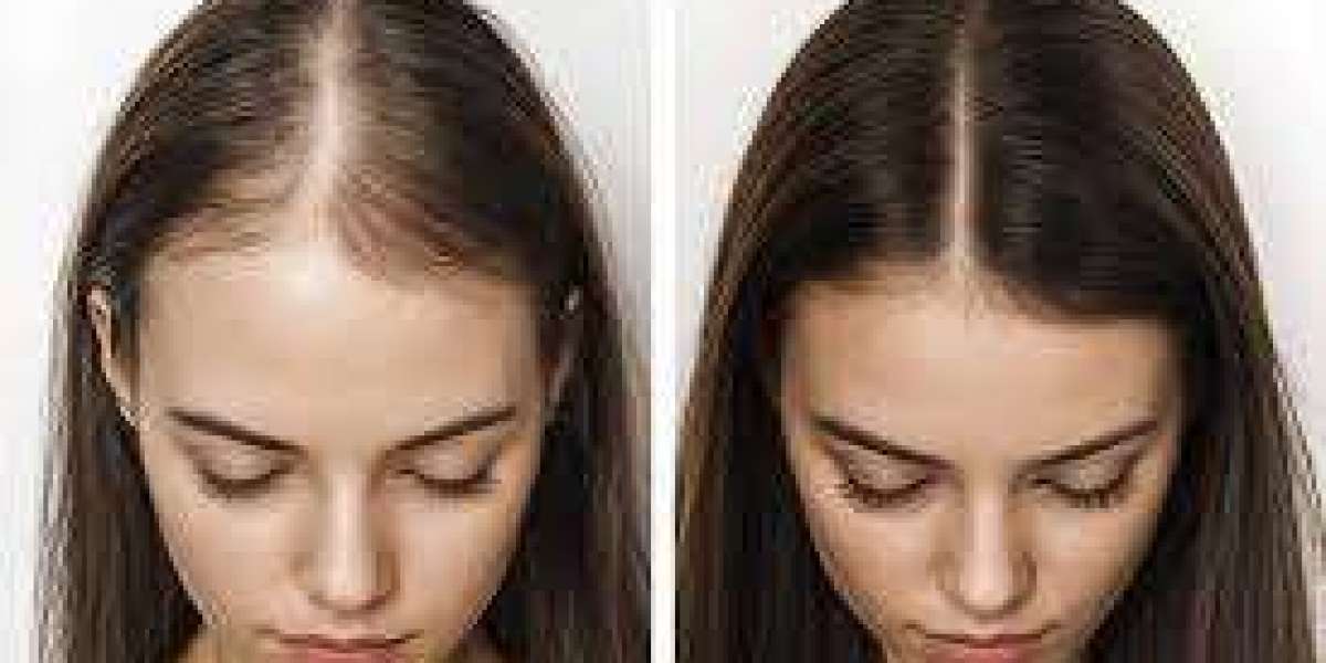 Hair Restoration Market gaining competitive edge with digital marketing strategies and influencer partnerships